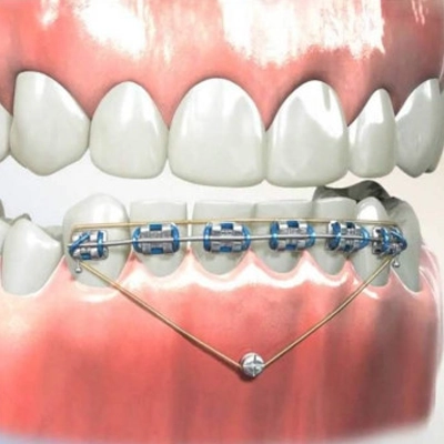 Getting Invisalign Invisalign in Tucson